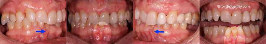 Frenum pull frein recession gingivale orthodontie 536379 GH 66 Tension d'un frein labial et récession gingivale