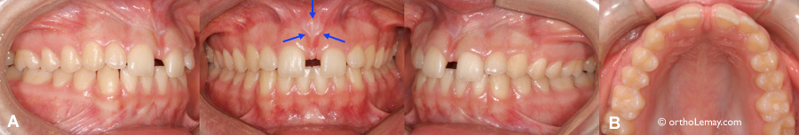 Frénectomie labiale faite pour fermer un espace inter dentaire (diastème)