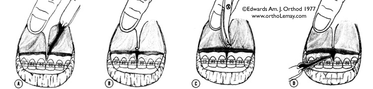 Illustration des étapes de la technique originale de frénectomie labiale telle que préconisée par Edwards en 1977 dans laquelle les tissus du frein labial sont excisés jusqu'au périoste recouvrant l'os. L'os alvéolaire est aussi dénudé par l'excision du périoste suivi d'une 'destruction" des fibres parodontales trans-septales (entre les dents). Edwards, Am. J. Orthod, may 1977. 