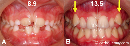 Eruption of canines that contribute to the closing of a diastema.