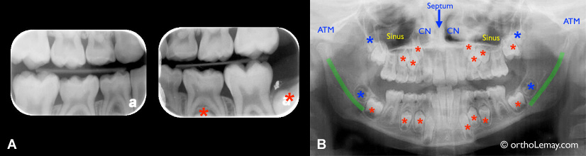 Comparaison entre différents types de radiographies dentaires utilisées en orthodontie. 