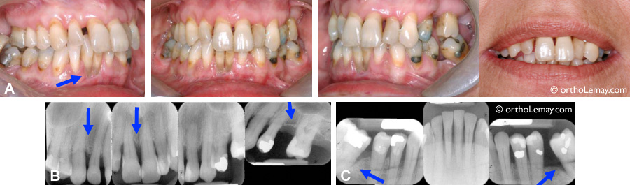 Problèmes parodontaux, perte osseuse, récession gingivale et traitement d'orthodontie 