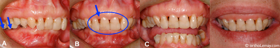 parodontie perte osseuse orthodontie sherbrooke 536323HP 48