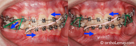 élastique orthodontique diagonal et vertical