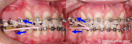 Élastique orthodontique classe 3 et horizontal