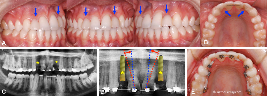 Position inadéquate des racines pour la pose d'implants dentaires