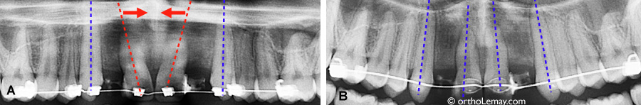 Redressement de racines des dents en orthodontie pour préparer un site pour implants dentaires.