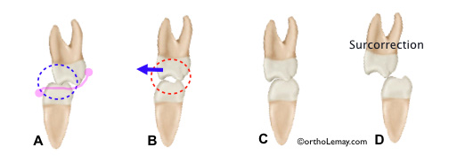 Correction d'une occlusion croisée postérieure et surcorrection avec un élastique orthodontique 