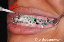 Un instrument permet de mesurer la force précise des élastiques à utiliser avec les appareils orthodontiques