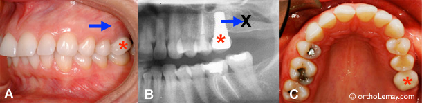 Installation of a dental implant before an orthodontic treatment that prevents moving backward the teeth.