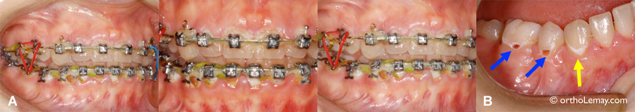 Décalcification et caries dentaires pendant un traitement d'orthodontie causé par une mauvaise hygiène buccodentaire