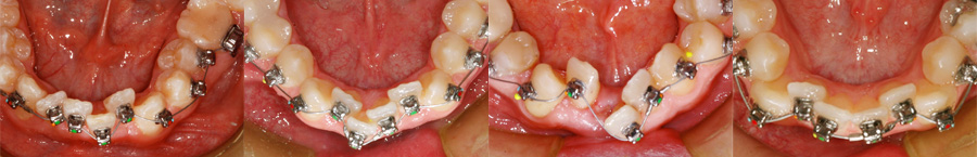 CuNiTi wire orthodontie sherbrooke 103247JB 113035 103196 Utilisation de super fils flexibles en orthodontie