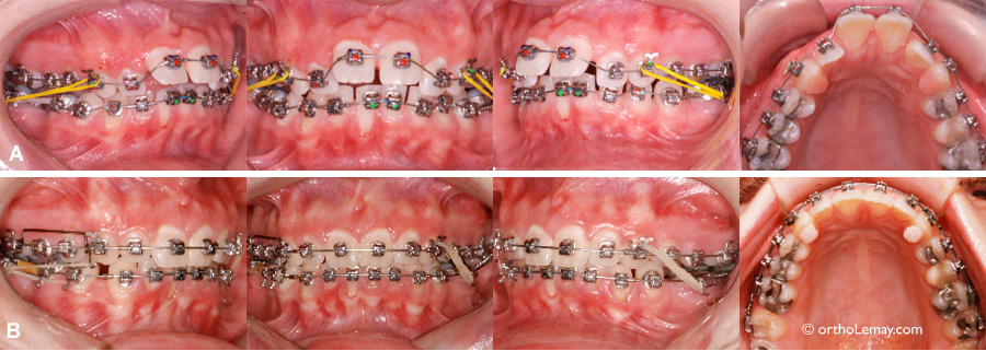 Fils (arc) flexible et rigide utilisés en orthodontie pour aligner les dents