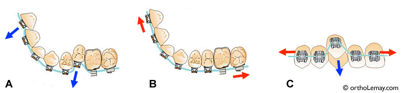 fil orthodontique mouvement dentaire orthodontiste Sherbrooke Fil orthodontique et alignement dentaire