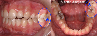 Decayed wisdom tooth to extract 