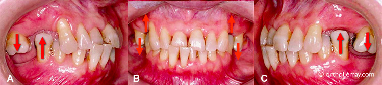 Extraction of teeth and resulting dental displacements.