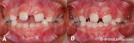 Béance antérieure et utilisation d'un écran oral (tongue crib for open bite)