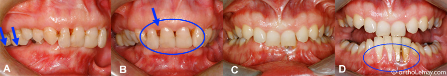 Perte osseuse, maladie parodontale et orthodontie