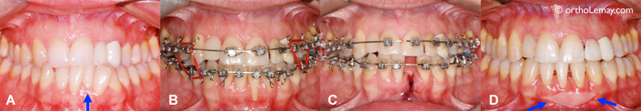 DÉchaussement, récession gingivale. Extration d'une incisive en orthodontie 