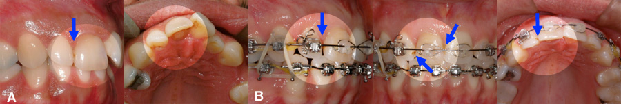 malocclusion dentaire et carie dentaire. Corrections orthodontiques