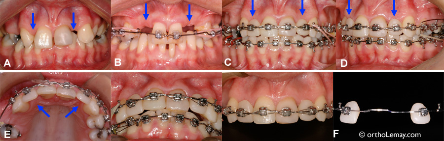 Dents prothétiques utilisées pendant un traitement d'orthodontie