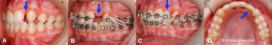 Remplacement d'une latérale manquante pendant l'orthodontie