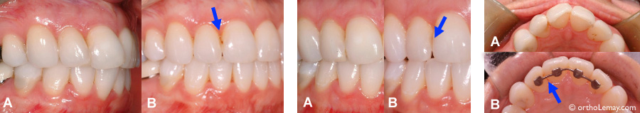 Carie dentaire entre deux dents en rotation et malocclusion dentaire. 