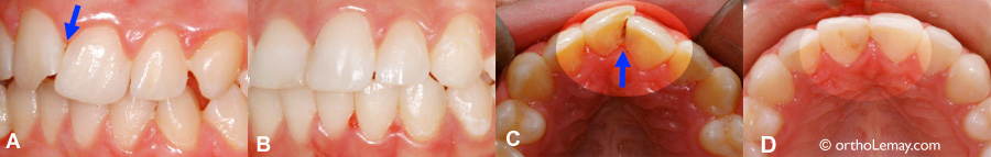 Carie dentaire et malocclusion traitée en orthodontie