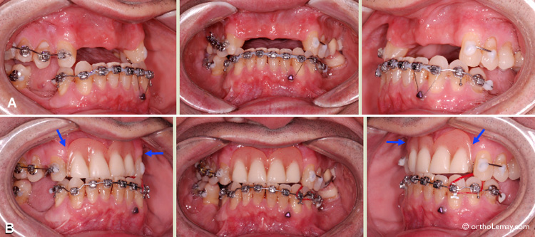 Traitement d'orthodontie pour patient adulte partiellement édenté et utilisation d'une prothèse dentaire partielle