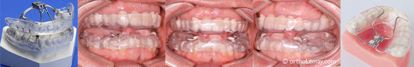 Appareil dentaire pour le traitement de l'apnée du sommeil et le ronflement, le Klearway