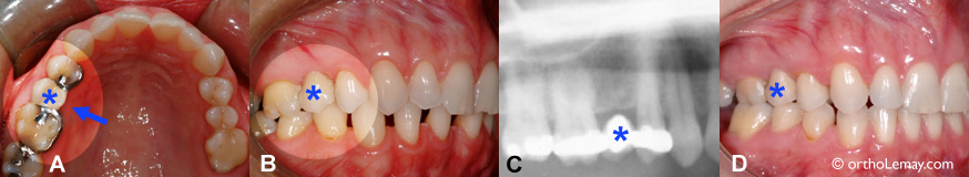 L'orthodontie est possible avec un pont (bridge) dentaire