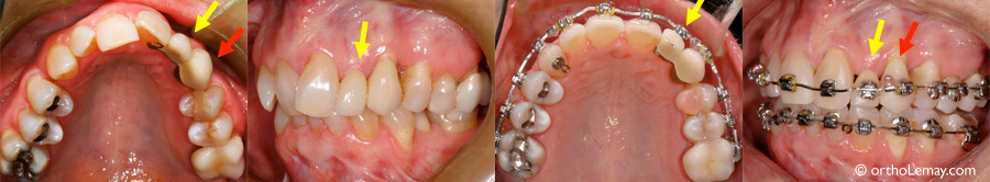 Boîtier orthodontique collé sur une dent en porcelaine