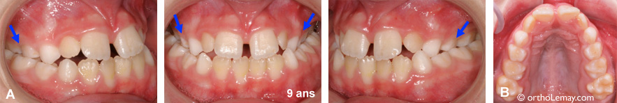 Ronflement et apnée du sommeil chez un enfant présentant une malocclusion avec occlusion croisée