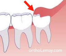 opercule dentaire recouvrant une dent de sagesse incluse et causant de l'inflammation et autres problèmes.