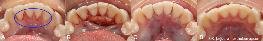 Mucogingival procedure to correct a lingual recession on incisors.