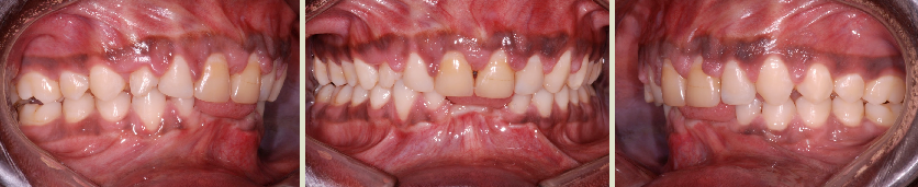 Orthodontic treatment of an adult with a very severe periodontal condition. Orthodontic treatment of an adult with a very severe periodontal condition.