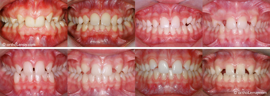 Exemples d'anodontie ou hypodontie des latérales supérieures et d'epaces inter-dentaires.