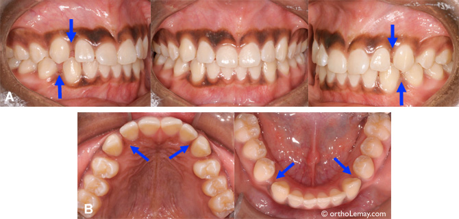 Espaces primates dans une dentition non traitée en orthodontie.