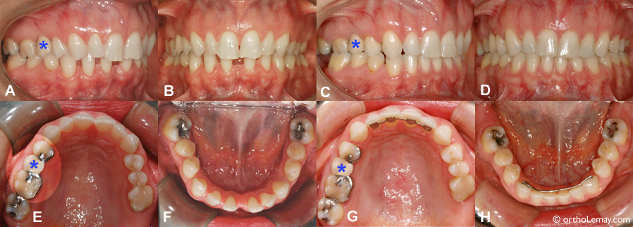 Fermeture d'espaces inter-dentaires et pression de langue