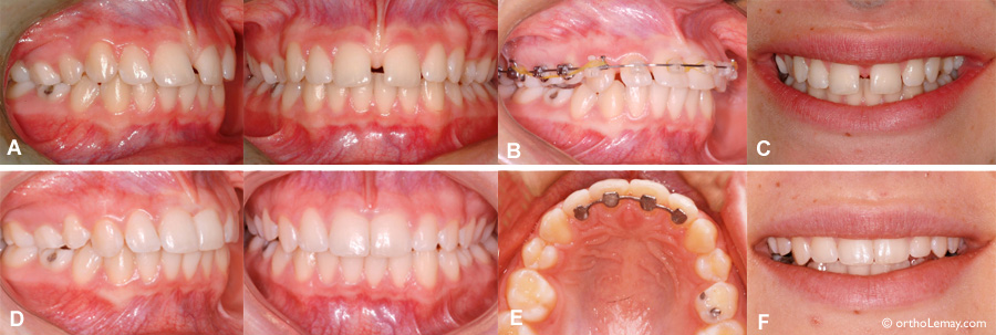 Fermeture d'un diastème central en orthodontie