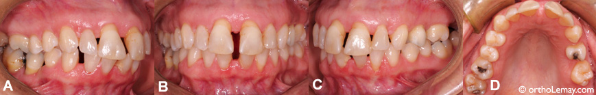 Espaces dentaires, parodontie, pression de langue et malocclusion 