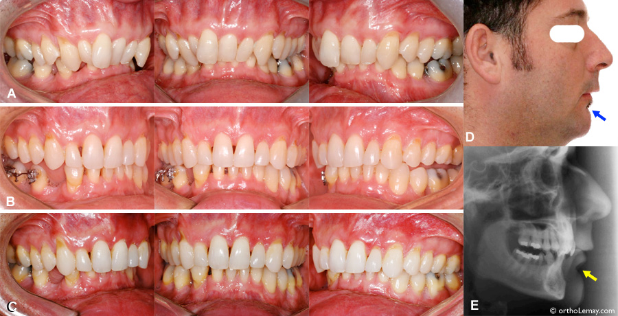 Traitement de compromis en orthodontie pour rétrognathie mandibulaire