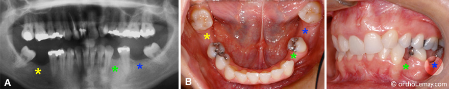espace extraction dentaire molaire orthodontie sherbrooke 123096 VD26