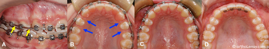 Fereture d'espaces inter-dentaires en orthodontie 