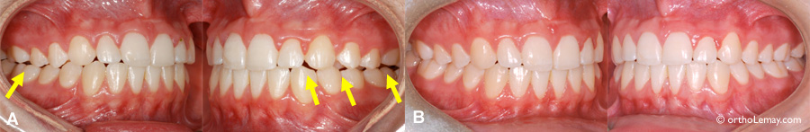 Manque de contacts entre les dents postérieures après l'orthodontie.
