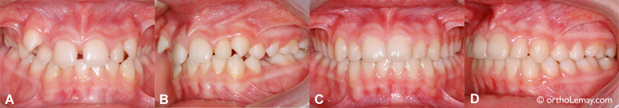 Fermeture d'un diastème en orthodontie 