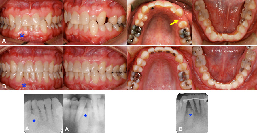 Incisive incluse et traitement d'orthodontie 