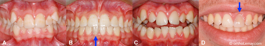 Exemples de décoloration dentaire apparue pendant un traitement d'orthodontie.