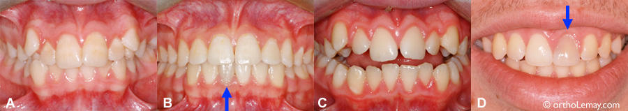 Decoloration traumatisme dentaire orthodontie 073084 MB17 093143 NG16 Exemples de décoloration dentaire apparue pendant un traitement d'orthodontie.