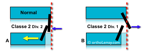 Correction orthodontique d'uen classe 2 division 2 avec compromis